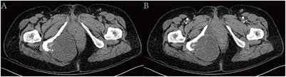 Extraskeletal myxoid chondrosarcoma of the buttock: a case report and literature review